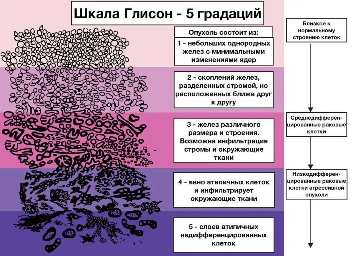 Глисон простата. Классификация Глисон предстательной железы. Гистологическая классификация опухолей предстательной железы. Предстательная железа гистологическая классификация. Ацинарная аденокарцинома простаты гистология.