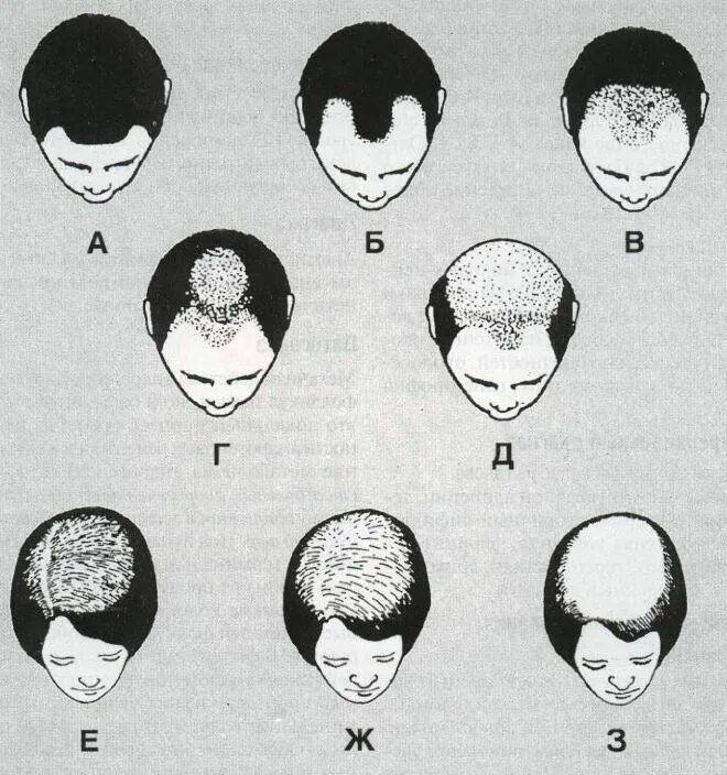 Виды затылков. Андрогенная алопеция алопеция. Шкала Людвига алопеция. Андрогенная алопеция Гамильтон. Андрогенная алопеция схема.