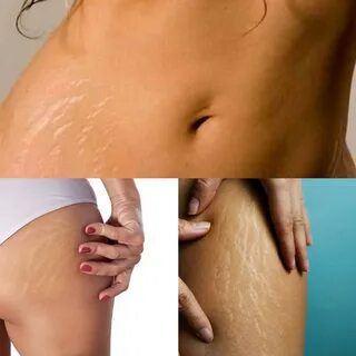 Kumpulan Produk Perawatan Stretch Marks Terbaik. 