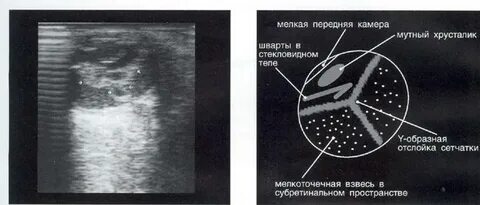 Узи зрительного нерва