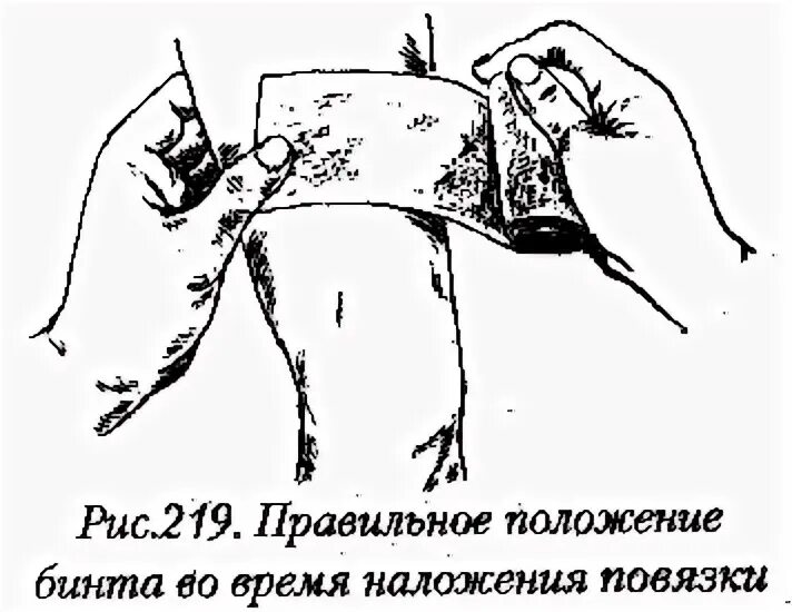 Наложение асептической повязки. Техника наложения асептической повязки. Наложение асептической повязки алгоритм. Асептическая повязка как накладывать. Наложение асептической повязки на рану