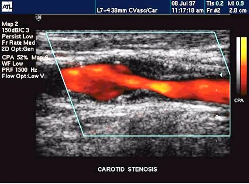 Тромбоз сонной артерии УЗИ. Атеросклероз сосудов шеи УЗИ. Атеросклероз сонных артерий УЗИ. Ультразвуковая допплерография сосудов шеи. Сужение шейных сосудов