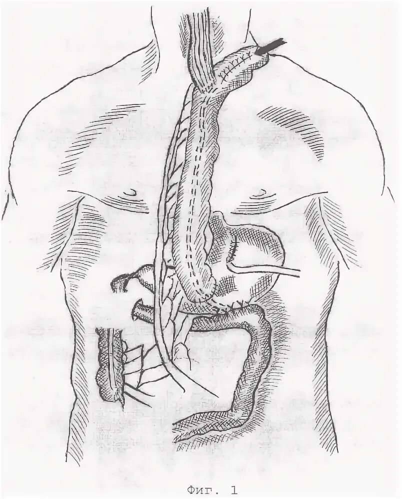 Анастомозы при резекции пищевода.  Операция Льюиса -экстирпация пищевода. Пищеводно-желудочный анастомоз рентген. Анастомоз пищевода