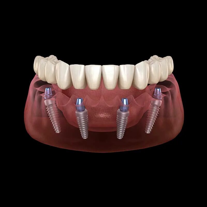 Протезирование на имплантатах. Имплантация зубов all on 4. Полная имплантация зубов.