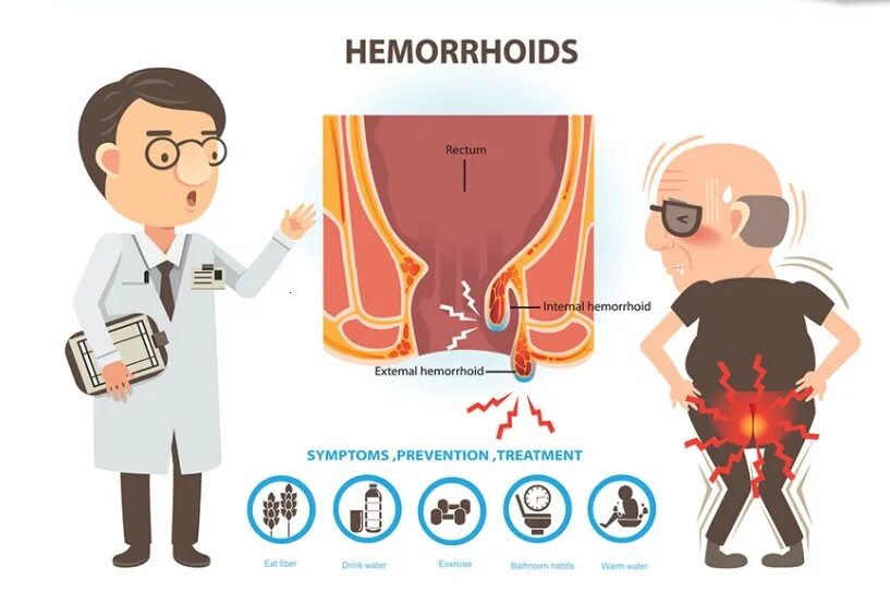 Геморрой этиология патогенез. Профилактика и лечение геморроя