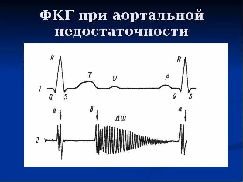 Графическое изображение фкг. Митральная недостаточность фкг. фкг при митральной недостаточности. фонокардиография при митральной недостаточности. фонокардиография физиология.