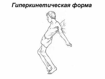 Гиперкинетическую дцп