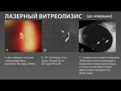 Лазерный витреолизис