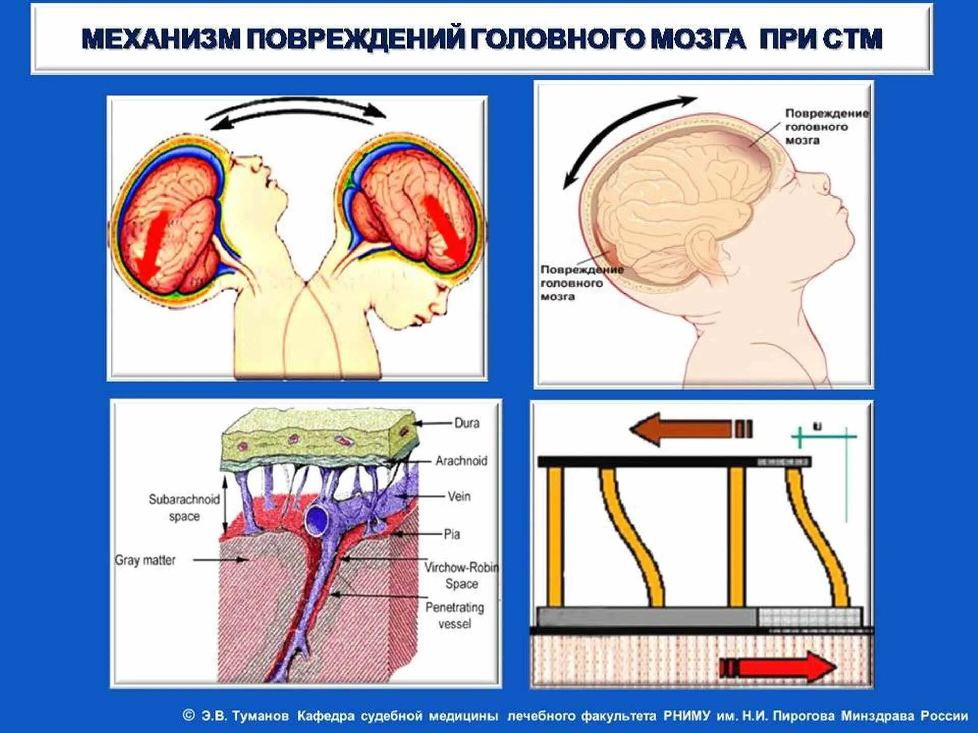 Сотрясение у новорожденных. Сотрясение мозга у дошкольника. Синдром детского сотрясения. Ушиб головного мозга механизм повреждения. Синдромы при ушибе головного мозга.