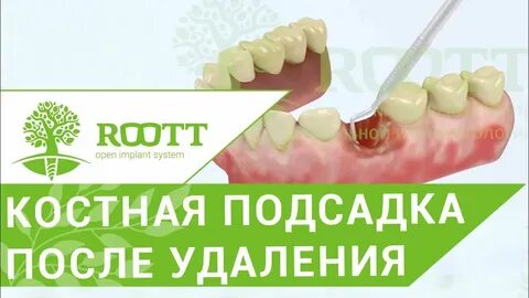 После наращивания кости