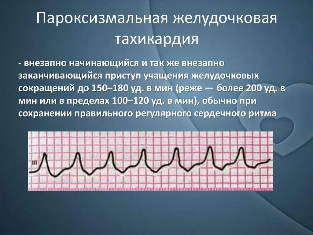 Желудочковая тахикардия на экг. Пароксизмальная желудочковая тахикардия. Пароксизмальная желудочковая тахикардия на ЭКГ. Пароксизм желудочковой тахикардии ЭКГ. Пароксизмальная тахикардия желудочков ЭКГ.