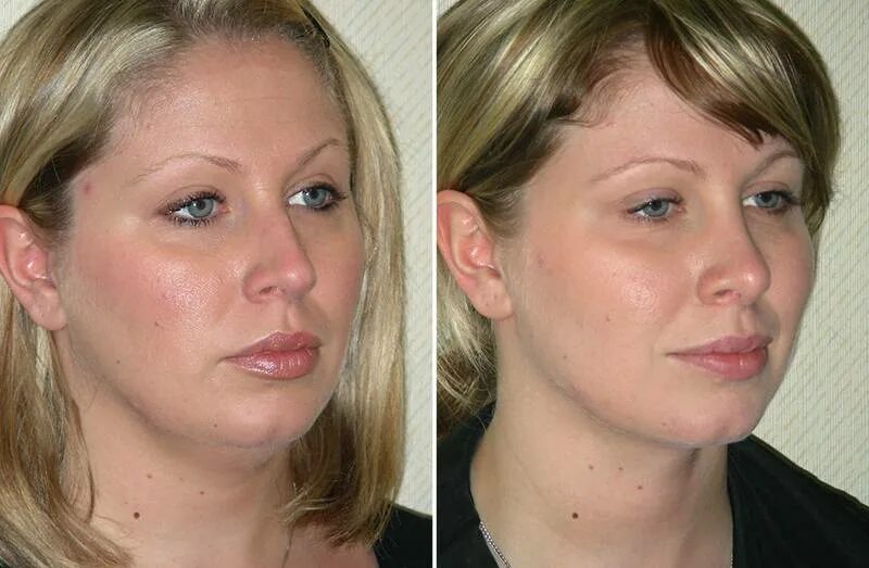 Липолитики для лица. Липолитики в брыли. Смас платизмопластика. Липолитики в брыли. Липолитики в брыли на лице.