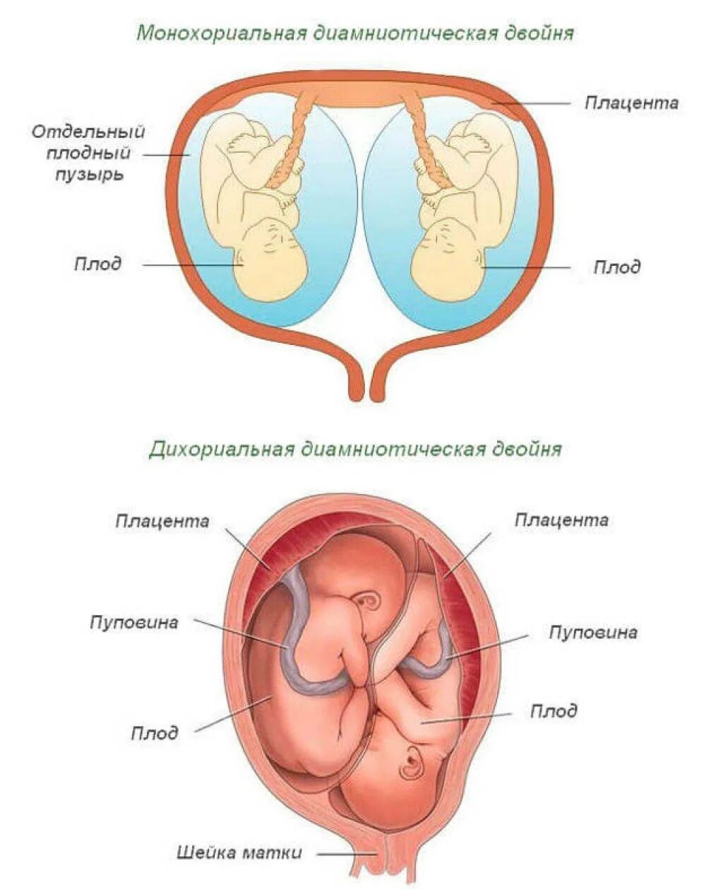 Матка многоплодной беременности