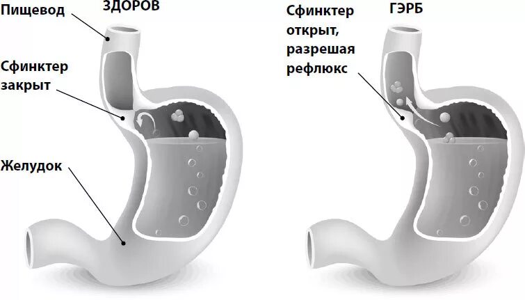 Клапан пищевода и желудка. Нижний пищеводный сфинктер. Кардиальный сфинктер желудка. Нижни пещеводны сфинктер. Нижний эзофагеальный сфинктер.