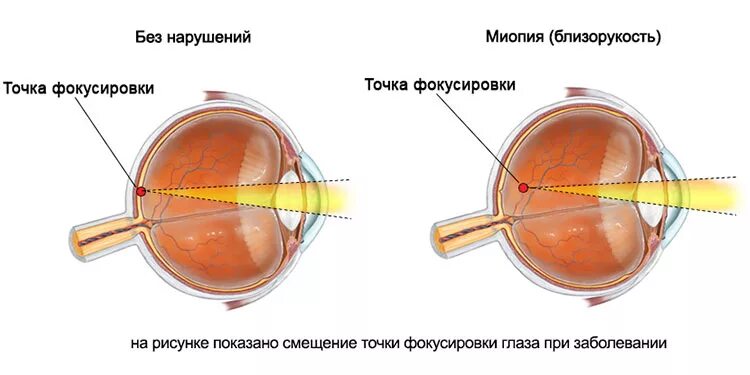 Фокусировка глаза человека. Миопия схема глаза. Заболевание органов зрения миопия. Нарушение зрения астигматизм. Близорукость и дальнозоркость схема глаза.