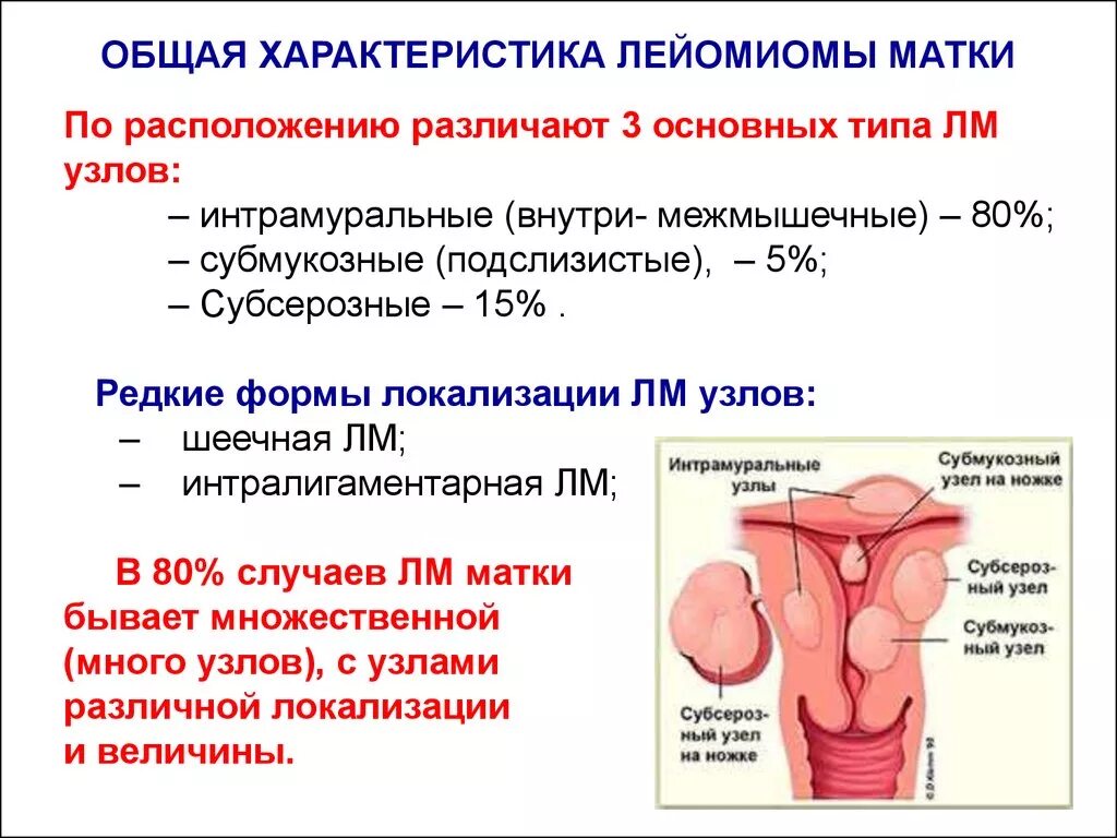 Лейомиома матки что это. Интрамуральная лейомиома матки. Патология шейки матки классификация. Интрамуральная-субсерозная лейомиома.