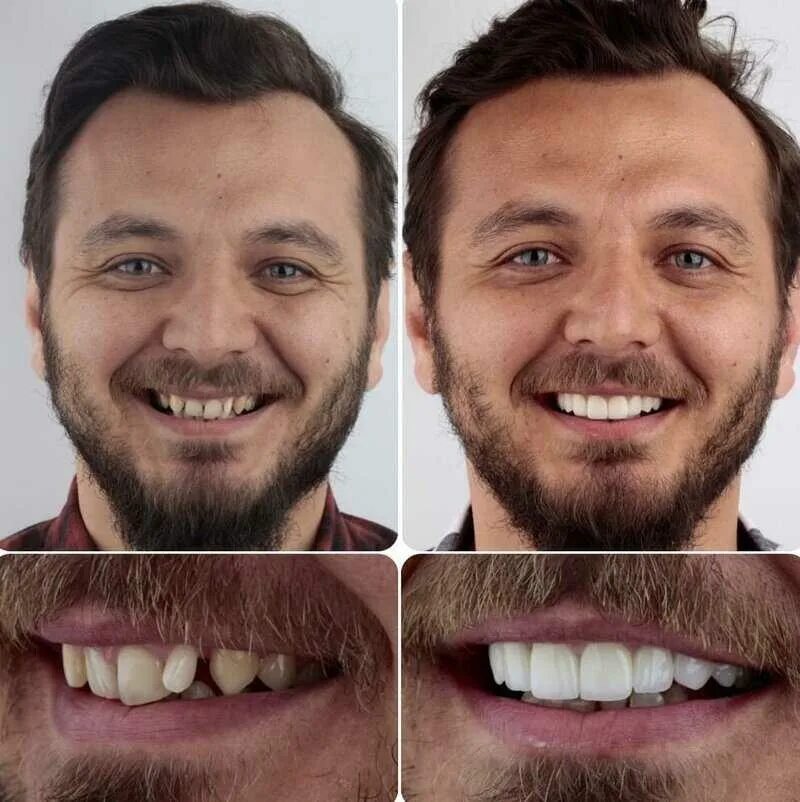 Зубы после 30. Красивая мужская улыбка. Красивые зубы до и после. Зубы мужские.