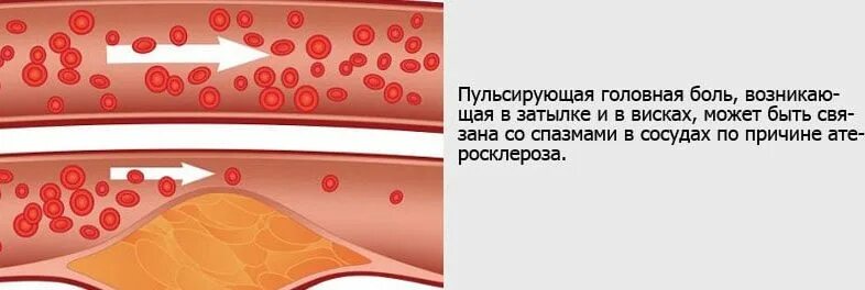 Затылок пульсирует и болит. Пульсирующая боль в голове. Пульсирующая головная. Пульсирующий головной боли.