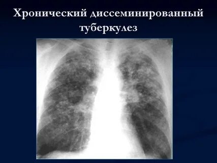 Диссеминированного туберкулеза легких