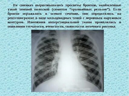 Полоски на легких