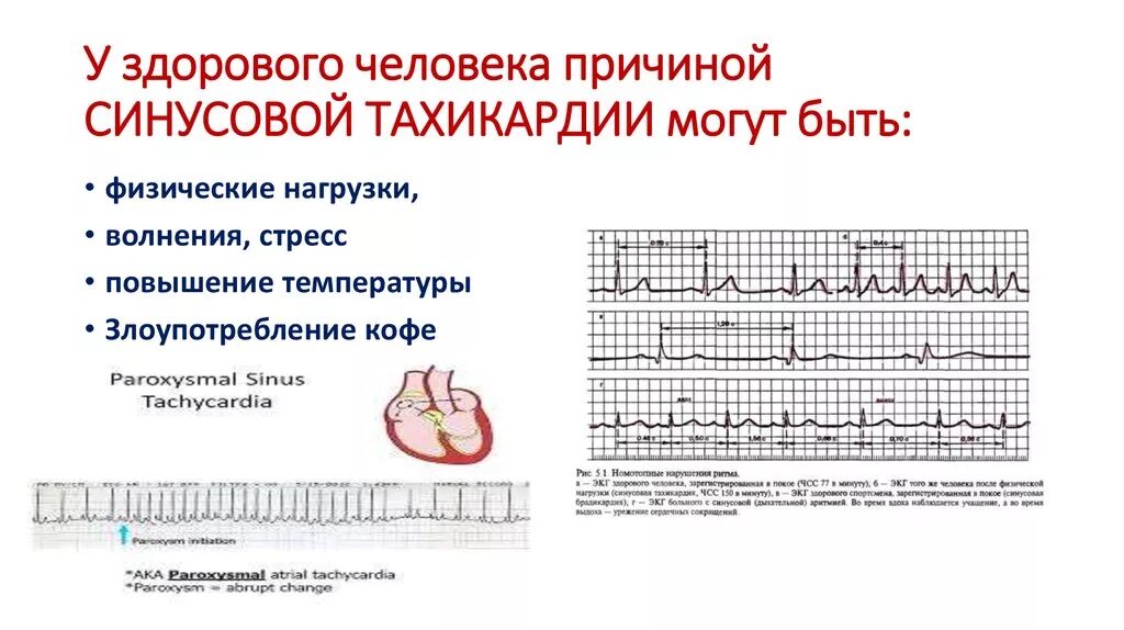 Сильное сердцебиение при нагрузках. Синусовая тахикардия симптомы. Синусовая тахикардия причины. Синусовая тахикардия клинические симптомы. Причины синусовой тахикардии у детей.