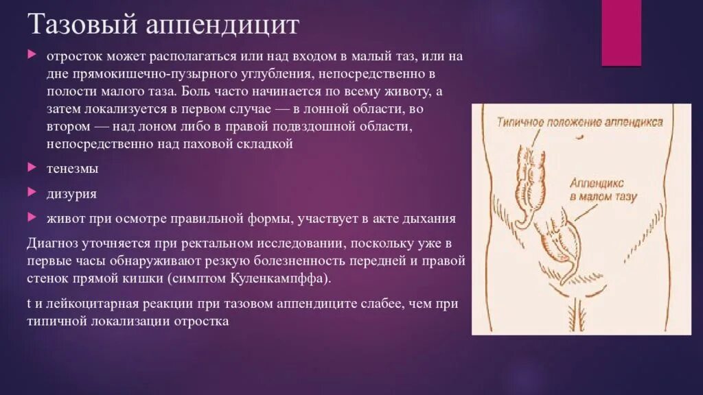 Аппендицит бывает у женщин. Аппендицит бывает у женщин