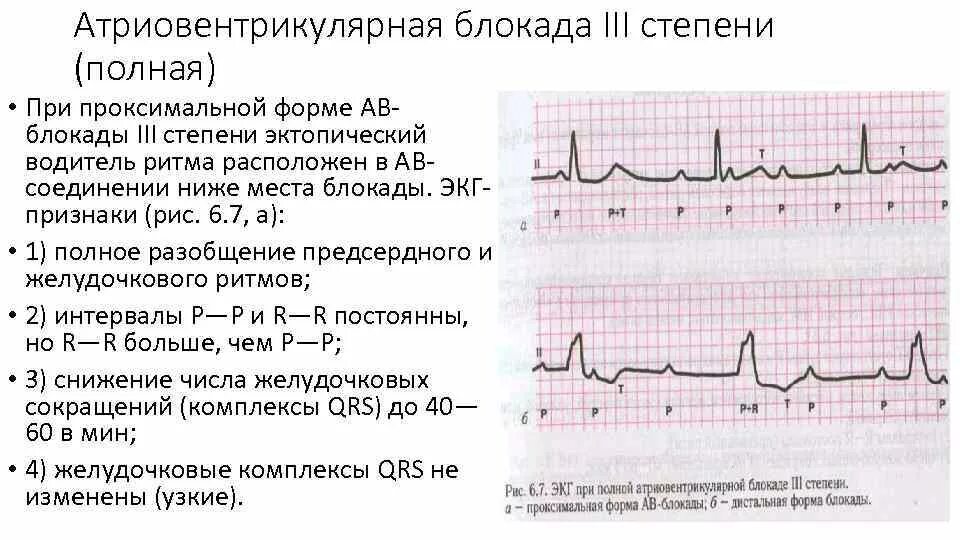 Полная атриовентрикулярная блокада. ЭКГ признаки полной атриовентрикулярной блокады. АВ блокада 2 степени Мобитц 1 на ЭКГ. Степени атриовентрикулярной блокады на ЭКГ. Полная АВ блокада 3 степени ЭКГ.