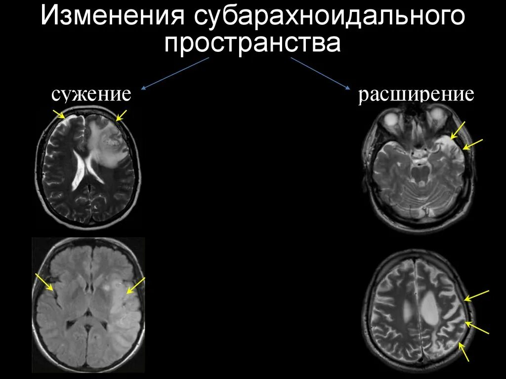 Субатрофические изменения мозга. Расширение субарахноидальное конвекситальное пространство. Субарахноидальное пространство головного мозга мрт. Мрт головного мозга расширение субарахноидального пространства. Расширение наружных ликворных пространств головного мозга на мрт.