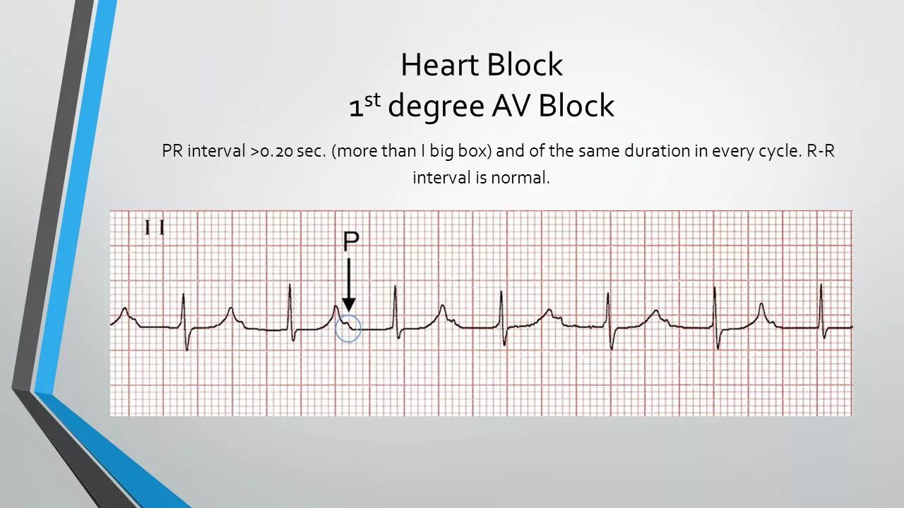 Интервал PR. Интервал PR на ЭКГ. PR интервал 152. Av Block 1st degree.