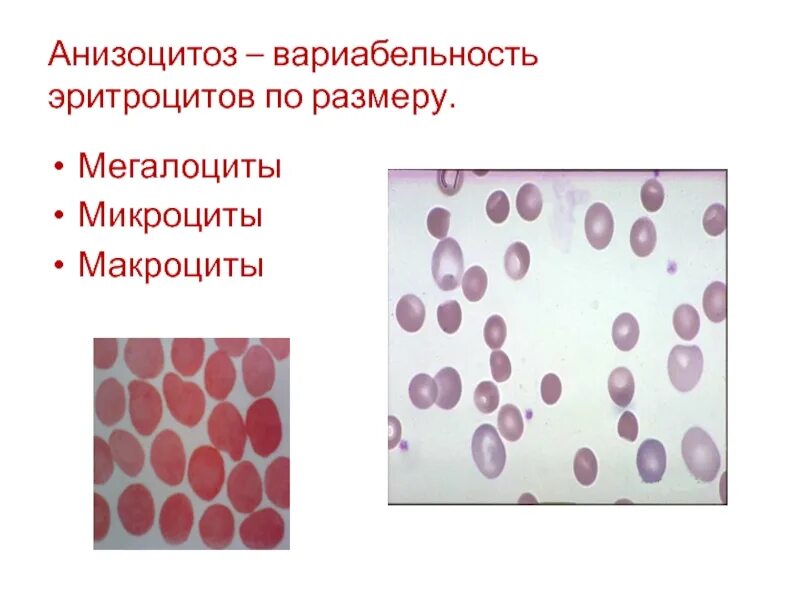 Микроциты повышены. Анизоцитоз пойкилоцитоз полихроматофилия. Анизоцитоз анемия. Микроцитоз анизоцитоз пойкилоцитоз. Анизоцитоз микроцитоз анемия.