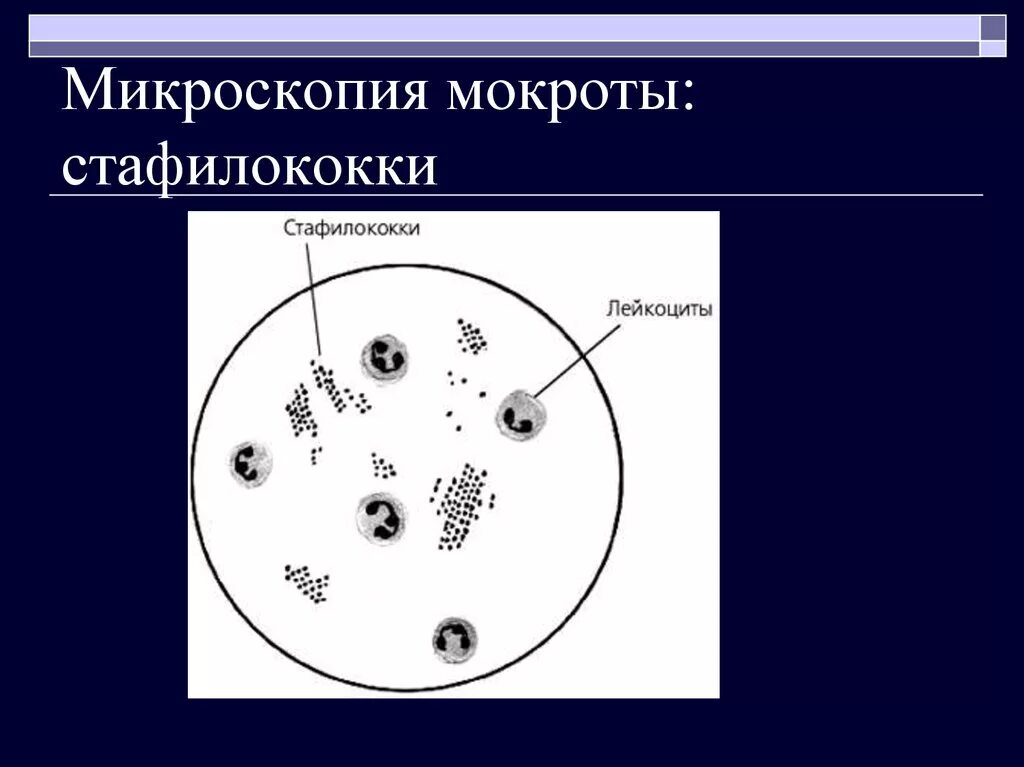 Элементы мокроты. Мокрота нативный препарат микроскопия. Эластические волокна в мокроте микроскопия. Микроскопическое исследование нативного препарата мокроты. Эпителий в мокроте микроскопия.