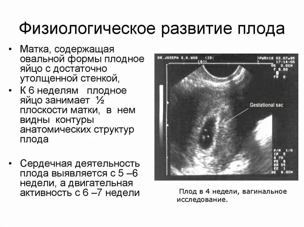 Плодное яйцо в матке 6 недель. Плодное яйцо продолговатой формы. Плодное яйцо овальной формы.