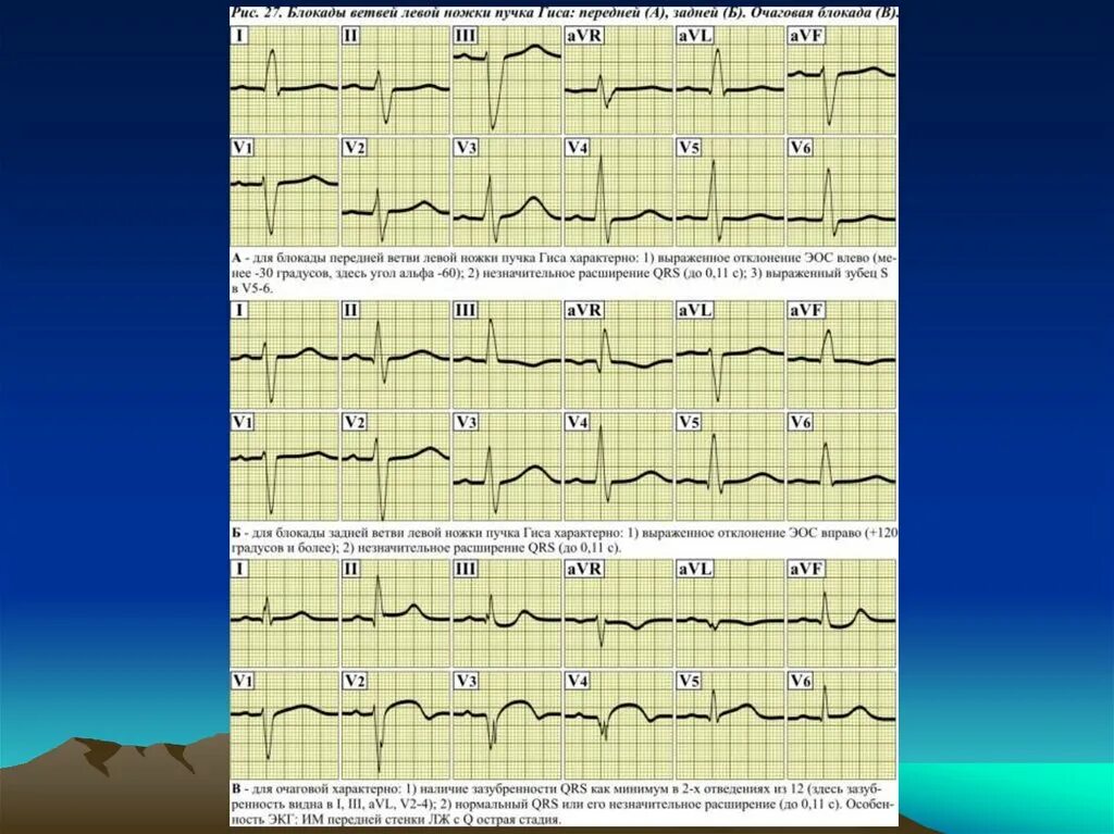Болезни на экг. ЭКГ-признаки нарушений функции АВТОМАТИЗМА.. ЭКГ при нарушении функции АВТОМАТИЗМА. Блокада передней ветви левой ножки. Блокада передней ветви ЛНПГ.