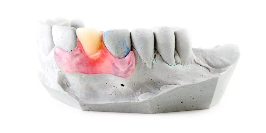 Бюгельный имплант бабочка. Микропротез бабочка на 2 зуба. Сделать зубы бабочки. Временный микропротез бабочка на 2 зуба. Бюгельный протез бабочка.