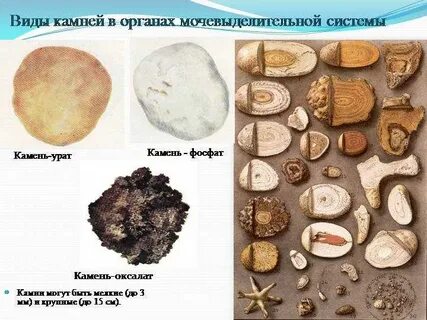 Анализ состава камней