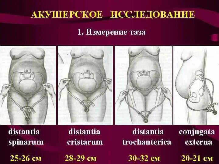 Измерение наружных размеров таза беременной алгоритм. Размеры таза в акушерстве дистанция спинарум. Методика измерения размеров таза. Измерение поперечных размеров таза.