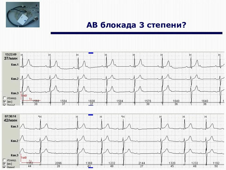 Атриовентрикулярная блокада 3 степени на ЭКГ. Полная атриовентрикулярная блокада 3 степени на ЭКГ. А-В блокада 3 степени на ЭКГ характеризуется. АВ блокада 3 на ЭКГ. Av блок