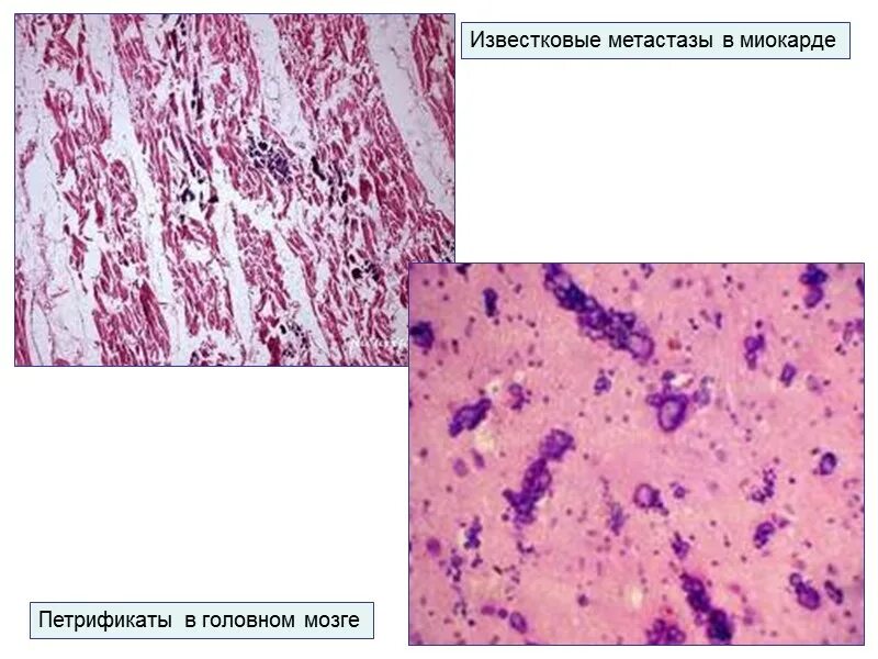 Метастазирование опухолей головного мозга. Метастазы опухолей головного мозга. Метастатические опухоли мозга. Метастатические опухоли мозга. Ганглионейробластома гистология.