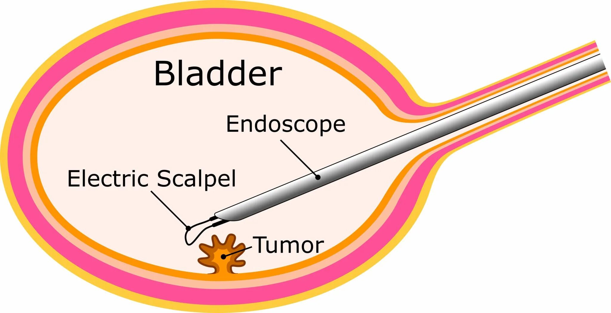 Treatment method. Neoadjuvant chemotherapy non muscle invasive bladder Cancer.