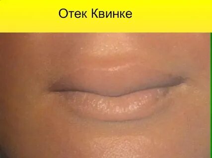 Внутренние отеки признаки