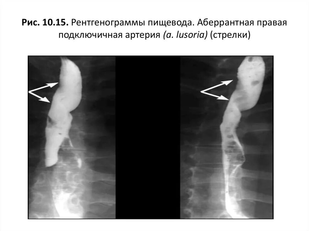 Аберрантная правая подключичная артерия кт. Сдавления пищевода a.lusoria. Рентгеноанатомия пищевода. Рентгенограмма пищевода.