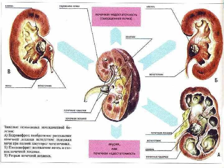 Нарушение процесса мочевыделения последствия. Последствия нарушения работы органов мочевыделения. Определение расстройств мочевыделения. Синдром Кона жалобы со стороны мочевыделения. Основные причины нарушения мочевыделения