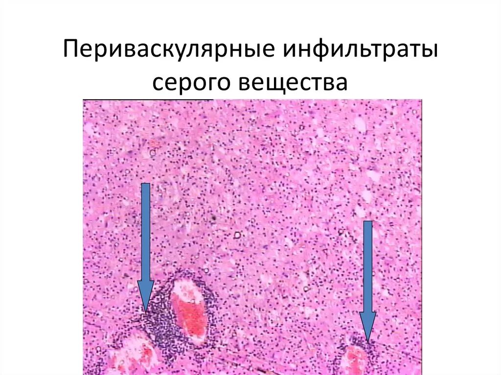 Смешанный периваскулярный инфильтрат при крапивнице. Смешанный периваскулярный инфильтрат при крапивнице