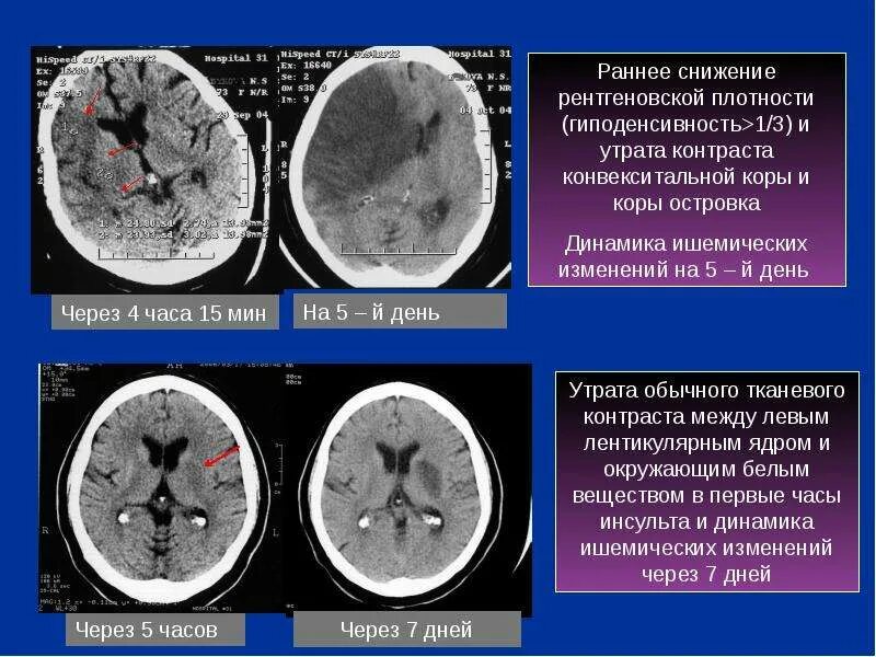 Ишемические изменения головного мозга. Ишемический инсульт на кт головного мозга. ОНМК по ишемическому типу мрт. ОНМК по ишемическому типу кт. Протокол кт головного мозга ишемический инсульт.