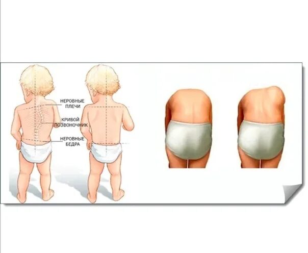 У ребенка в пояснице. Рахит деформации костей. Искривление позвоночника при рахите. Сколиоз позвоночника e ltntq.