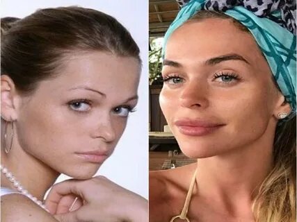 Хилькевич до пластики