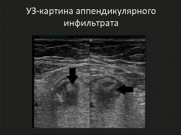 Абсцесс при аппендиците. Периаппендикулярный инфильтрат. аппендикулярный инфильтрат на узи. периаппендикулярный абсцесс. аппендикулярный инфильтрат и абсцесс.