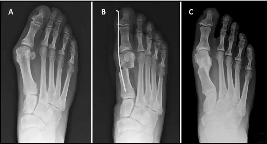 Пальцев 1 том. Остеотомия Wilson 5 плюсневой кости стопы. Вальгус 1 пальца стопы рентген. Степень деформации халюкс вальгус. Халюс вальгус степени на рентгене.