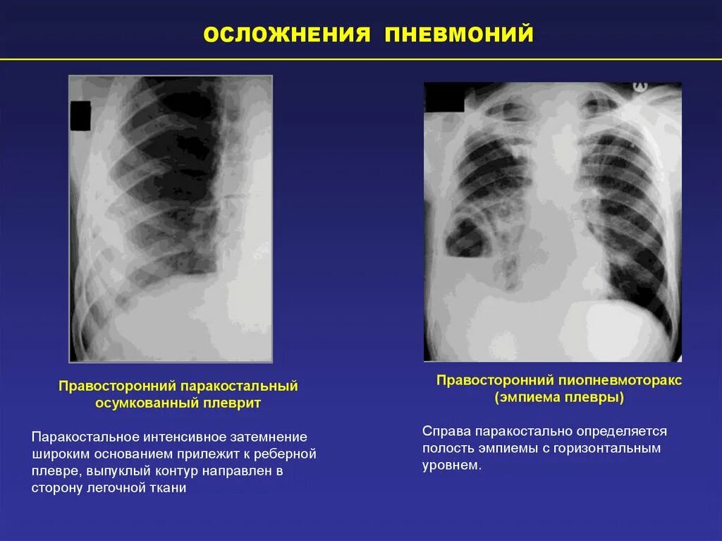 Плевральные осложнения. Паракостальный плеврит рентген. Паракостальный осумкованный выпот рентген. Парамедиастинальный плеврит рентген. Осумкованный плеврит рентген признаки.