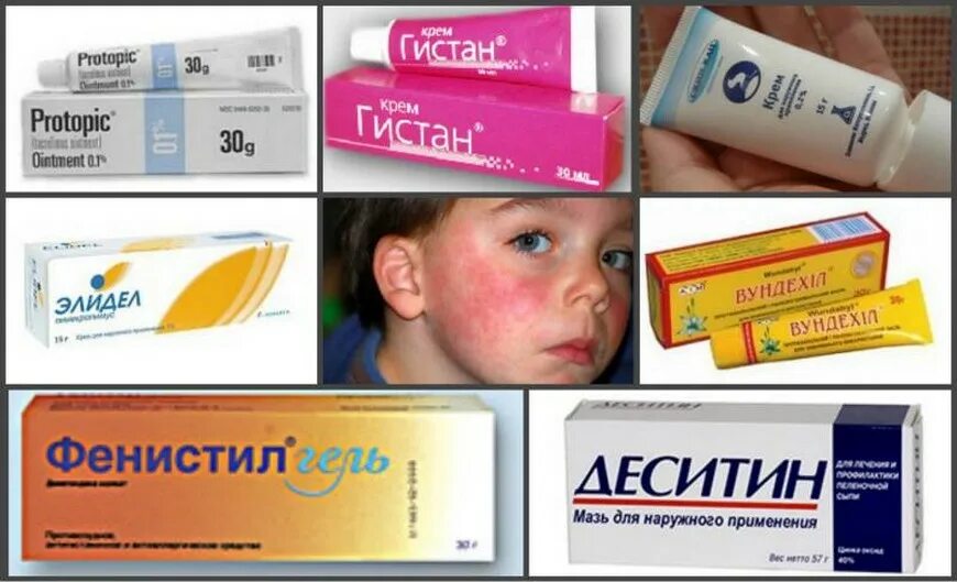 Мазь от аллергии для детей. Мазь от атопического дерматита для детей. Мазь от аллергии на лице у ребенка. Аллергия на солнце какие таблетки помогут